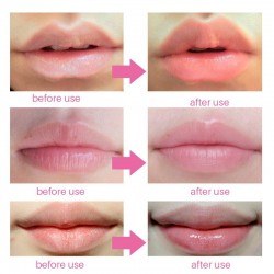Lip Gel Mask - 5PcsMondmaskers