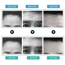 Removal Anti-wrinkle Stickers - Anti-aging - Lifting MaskHuid