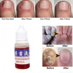 Médecine chinoise - réparation des ongles pour onychomycose - mycose des ongles - 10 ml