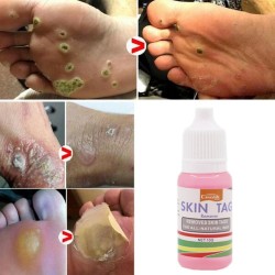 Skin tag removal - foot warts - medical liquid - 10ml - 2 piecesSkin