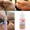 Skin tag removal - foot warts - medical liquid - 10ml - 2 piecesSkin