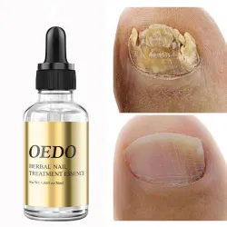 Schimmelnagelbehandeling - etherische olieBehandeling